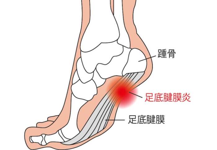 足底筋膜炎原因 足底筋膜炎原因