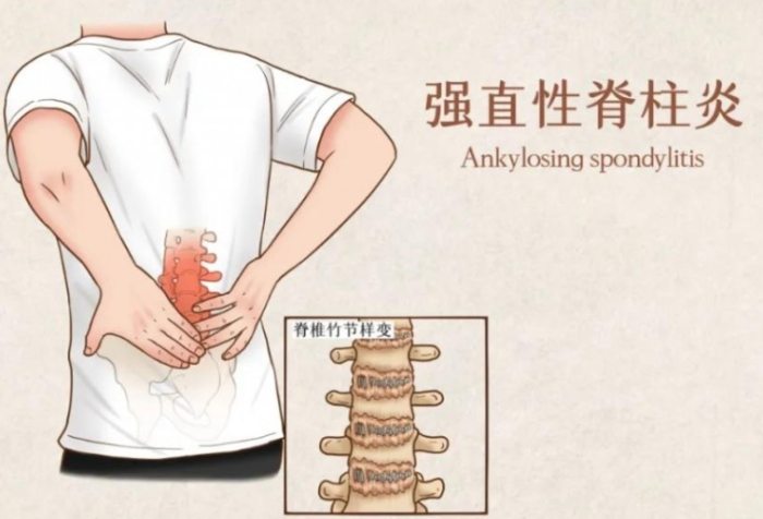 強直性脊椎炎原因 強直性脊椎炎原因