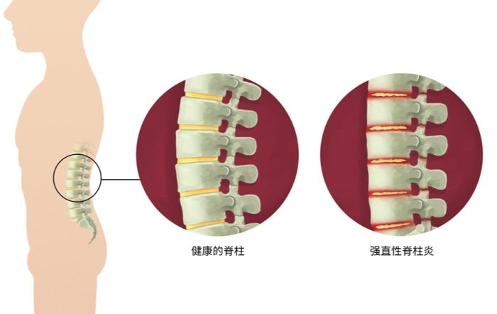強直性脊椎炎
