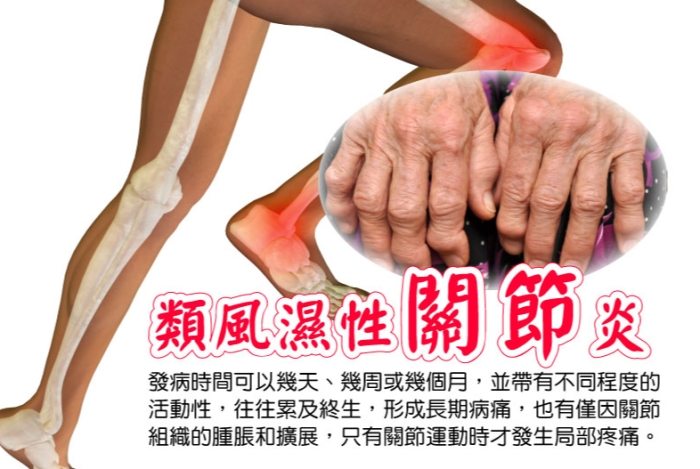 類風濕性關節炎症狀 類風濕性關節炎症狀
