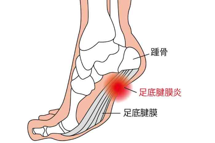 足底筋膜炎原因 足底筋膜炎原因