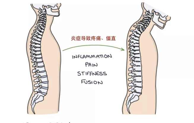 強直性脊椎炎壽命 強直性脊椎炎壽命