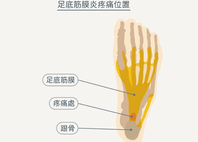 足底筋膜炎症狀 足底筋膜炎症狀