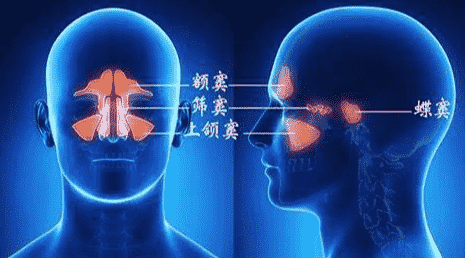 鼻竇炎原因 鼻竇炎原因