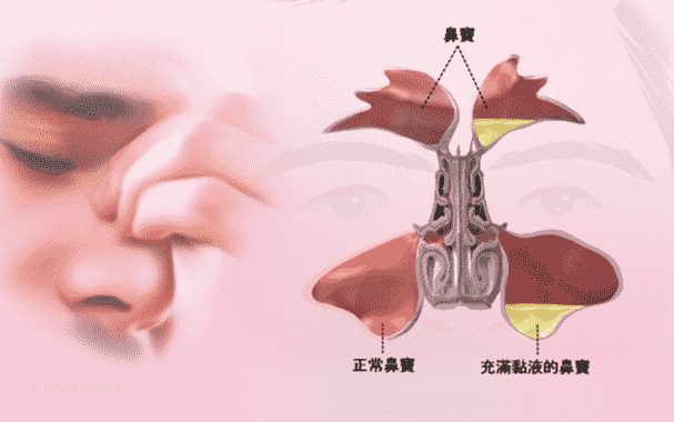 鼻竇炎症狀表現 鼻竇炎症狀表現