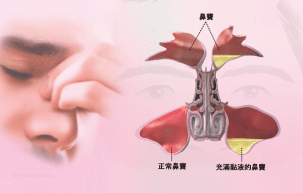 鼻竇炎的治療方法 鼻竇炎的治療方法